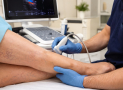 ¿Qué debes valorar en un tratamiento de varices sin cirugía?