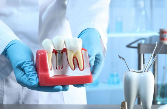 Tipos de implantes dentales: características y en qué casos se recomiendan